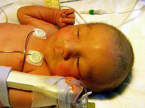 Причины заболевания желтухв у новорожденного
