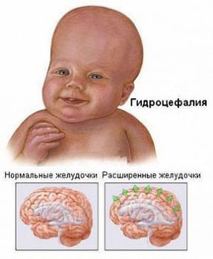 Гидроцефальный синдром у новорожденных 